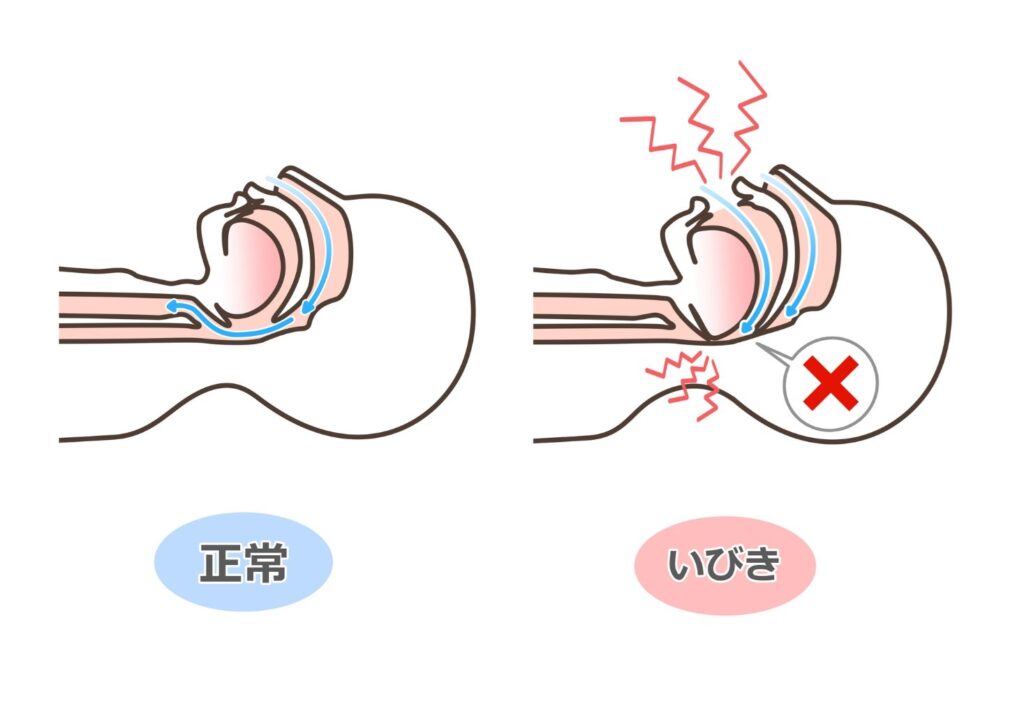 いびきが起きる時の断面図